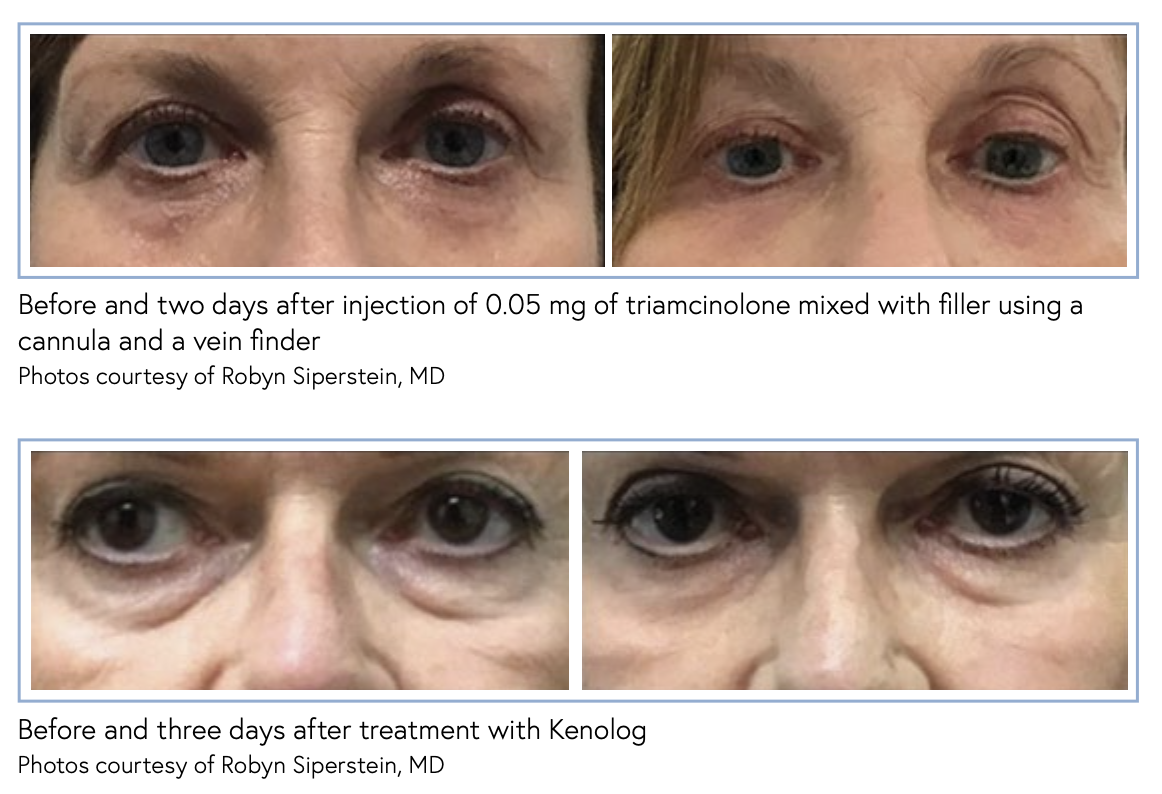 Triamcinolone to Infraorbital Filler Treatment theaestheticguide